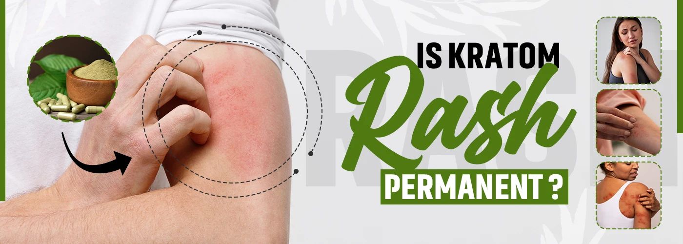 Is Kratom Rash Permanent?